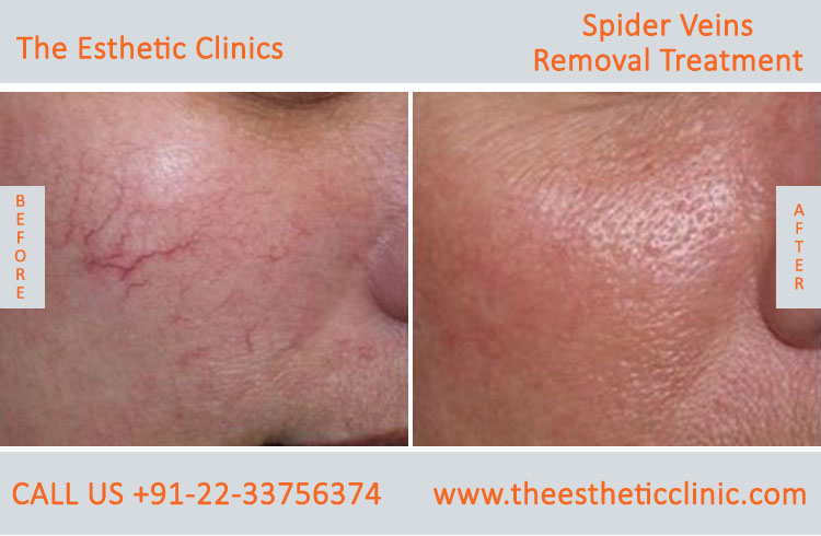 Spider Veins Removal Varicose Veins Laser Treatment before after photos mumbai india (1 (5)